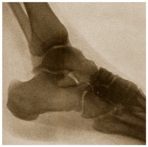 X Ray of an Ankle by German School