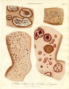 Pathological Skin Conditions: Schurigie, Leprous Skin, Pallada and Impetigo