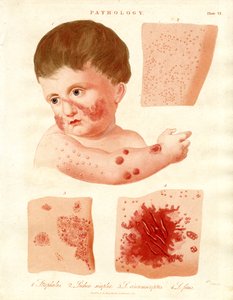 Pathological Skin Diseases