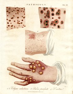 Skin Diseases: Ecthyma, Purulent Scabies, and Smallpox