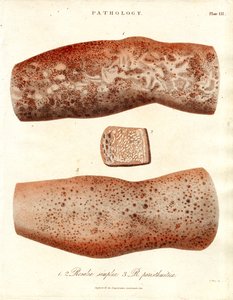 Skin Eruptions - Roseola simplex and Roseola paristhmitica