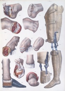 Amputations and Prosthetics, plate from 