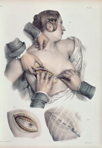 Operating on a cancerous tumour, from 