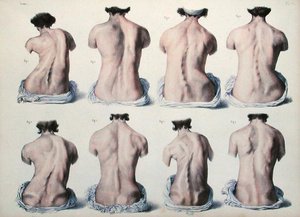 Spinal Deformities, Plate from 
