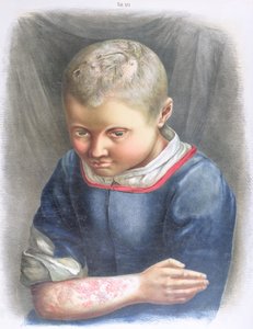 Favus, from a Book by Daniel Cornelius Danielssen, 1892