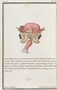 Cross-sectional diagram of a baby pulled from the womb by the arm, from a book by Madame Angelique Le Boursier du Coudray engraved by J. Robert by P. Chapparre