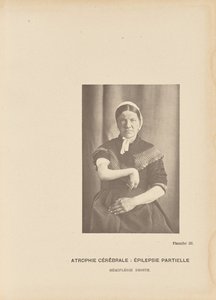 Cerebral Atrophy: Partial Epilepsy Right Hemiplegia