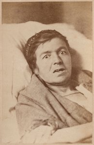 Hysterical epilepsy, face contraction, plate VIII from 