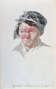 Syphilic Cluster Pustules, from a Book by Baron Jean Louis Alibert, 1838