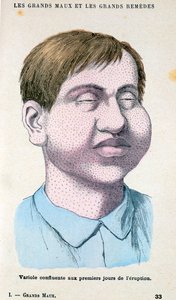 Smallpox Victim, c1890