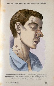 Symptoms of the Tertiary Phase of Syphilis, 19th century