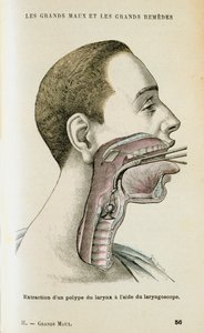 Using a Laryngoscope to Aid the Removal of a Polyp from the Throat