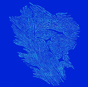 Crossing section of fibro-nucleated tumors