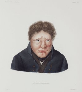 Diseases, Leprosy Male leper, Iceland, early 19th century