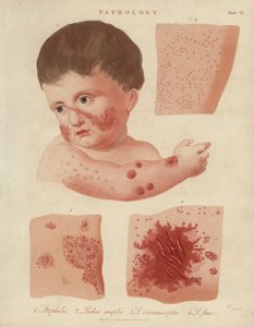 Skin Diseases of Infants