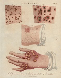 Skin Ulcer and Scabies