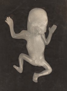 Degree of Ossification of a Five-Month-Old Fetus by Unknown