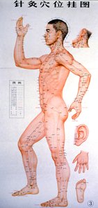 Acupuncture