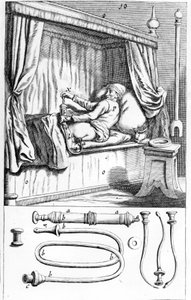 Clystère (for enemas) by Johannes Sculptetus 