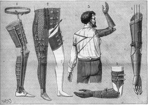 Modern apparatus for amputees. 1) artificial leg with belt, 2) apparatus for disarticulated thigh, 3 and 4 artificial arms invented and built by M.L Matthieu for the late Roger, 5) artificial arm with hand, thumb and index finger. in 