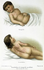 Scarlet Fever and Measles - 19th Century