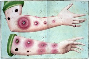 Symptoms of smallpox disease causing an outbreak of pustules on the skin. Medical plate from the “Vaccination Treat” by Luigi Sacco, Milan