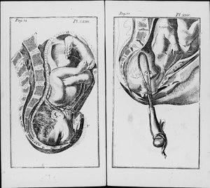 Birth of a Baby with Use of Forceps