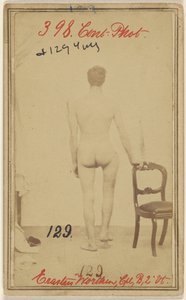 Fracture of the Upper Third of the Femur, Erastus Worthen, Corp Co. B. 2nd Vermont Vols, Aged 25, Residence Stockbridge VT by Unknown artist