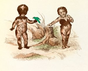 Little Girl Covered with Hairy Spots (engraving)