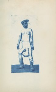 Elephantiasis, c. 1870s by Unknown photographer