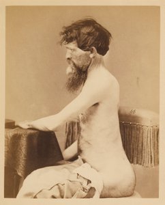 Private John Bar, Recovery after a Penetrating Wound of the Abdomen with Fracture of the Left Os Innominatum, from the Photographic Catalogue of the Surgical Section by William Bell