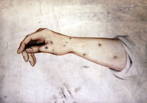 Study of a Forearm with skin condition, c.1850 by William Lover