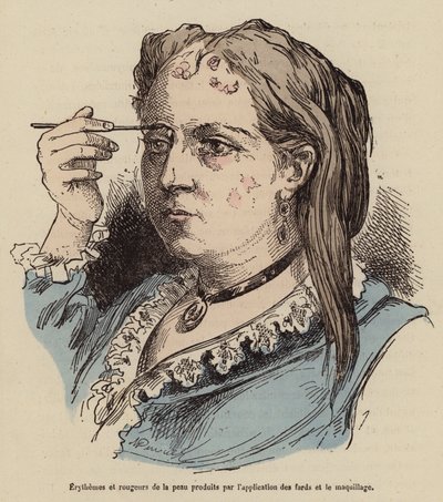 Woman with Skin Rashes and Redness Caused by the Use of Make-Up by (after) French School