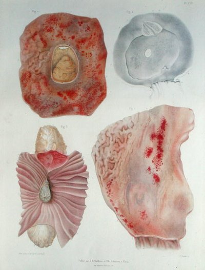 Organs infected with cholera, from 