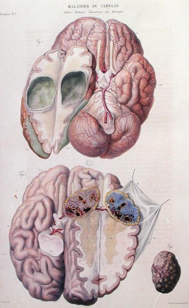 Cancerous tumours of the brain, from 