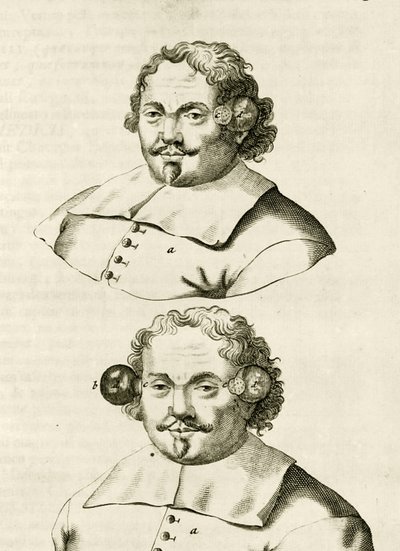 An example of cupping, from Exercitationes Practicae circa Medendi Methodum by Frederik Dekkers, 1694 by Dutch School