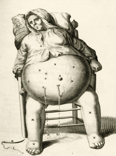 Draining fluids from an abscess, from Exercitationes Practicae circa Medendi Methodum by Frederik Dekkers, 1694 by Dutch School