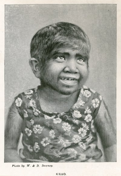 Krao, The Missing Link, Exhibited at the Aquarium, Westminster, London, in 1887 by English Photographer