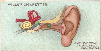 Foreign Body in Ear, no. 30 from the First Aid series of Wills cigarettes cards, 1913 by English School