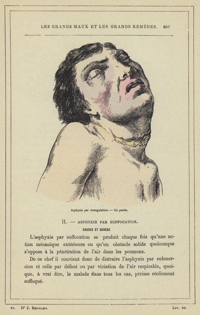 Asphyxia by strangulation, a hanged man by French School