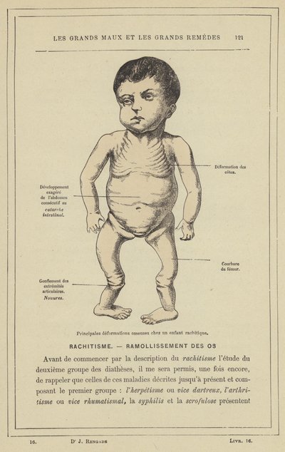 Main Bone Deformations in a Rachitic Child by French School