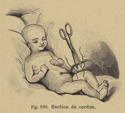 Cutting of a Newborn Baby