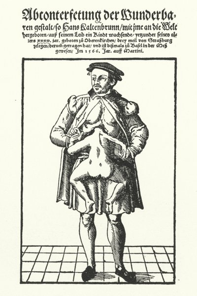 Hans Kaltenbrunn and his undeveloped conjoined twin (engraving) by German School