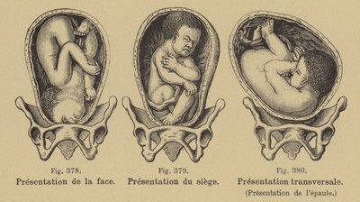 Malpresentation of Babies in the Womb Before Birth by German School
