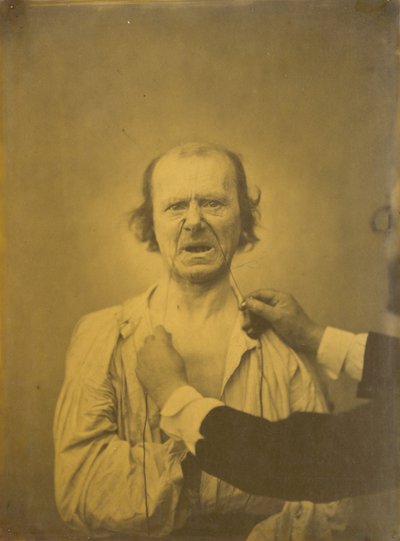Discontent, Bad Humor, 1854-1856, Printed 1862 by Guillaume-Benjamin-Armand Duchenne de Boulogne