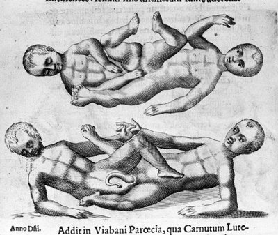 Different types of human monsters: Siamese children connected by the pelvis. Engraving from “De monstrorum natura, causis et differentiis” by Fortunio Liceti (1577-1656), Italian scientist. 1646 by Italian School