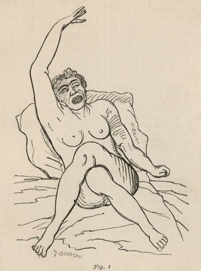 Hysterical Epilepsy, Attack, Contortions, fig. 1 from 