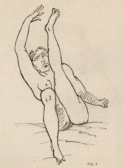 Hysterical epilepsy, attack, contortions, fig. 2 from 