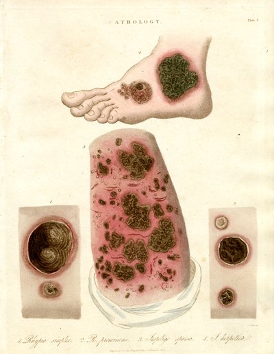 Pathological Skin Conditions - Pityria, Impetigo and Syphilis by John Pass