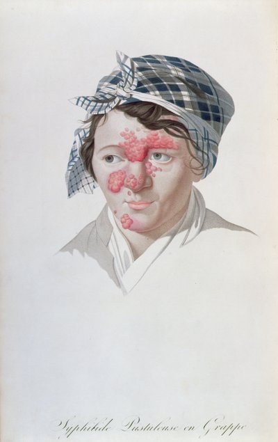 Syphilic Cluster Pustules, from a Book by Baron Jean Louis Alibert, 1838 by Salvadore Tresca